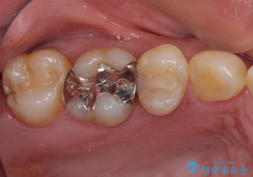 奥歯がしみる むし歯と知覚過敏の補綴治療 の治療前