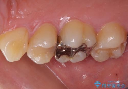 奥歯がしみる むし歯と知覚過敏の補綴治療 の治療前