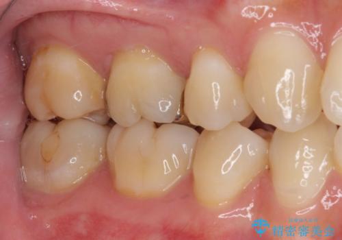 奥歯がしみる むし歯と知覚過敏の補綴治療 の治療前