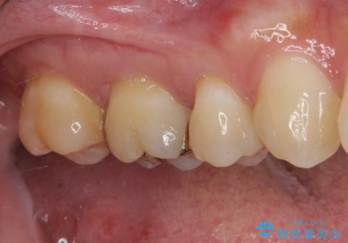 奥歯がしみる むし歯と知覚過敏の補綴治療 の治療前