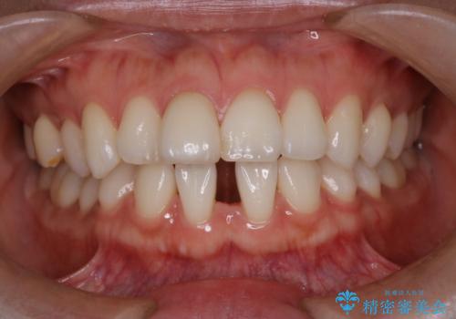 【オールセラミッククラウン】前歯の被せ物の症例 治療前