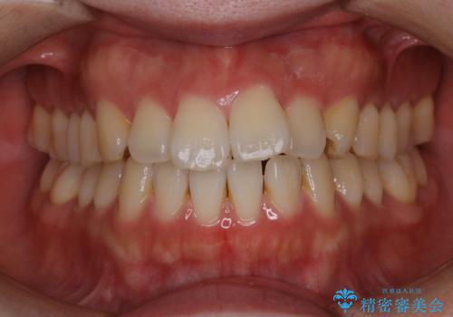 PMTCでステインの除去 の治療前