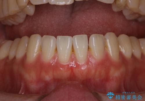 PMTCでステインの除去 の治療前