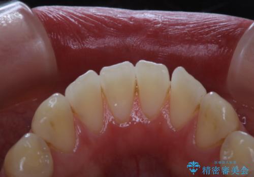 PMTCでステインの除去 の治療前