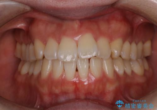 PMTCでステインの除去 の治療後