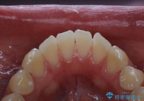 PMTCでステインの除去 の治療後