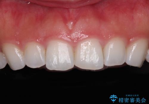 前歯の形を変えたい　前歯のラミネートベニア治療の症例 治療前