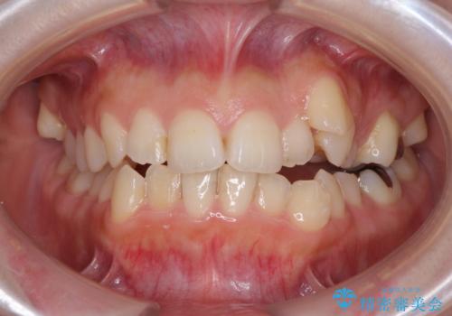 顕著な八重歯をインビザラインで治せるところまで改善の症例 治療前