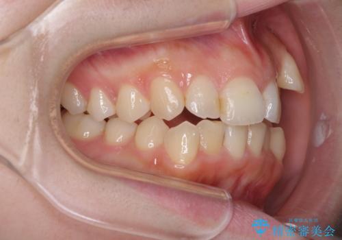 顕著な八重歯をインビザラインで治せるところまで改善の治療前