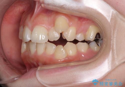 顕著な八重歯をインビザラインで治せるところまで改善の治療前