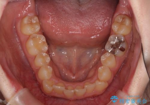 顕著な八重歯をインビザラインで治せるところまで改善の治療前