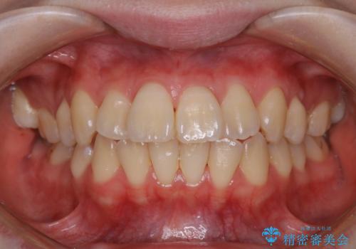 オフィスホワイトニングで白い歯にの治療前