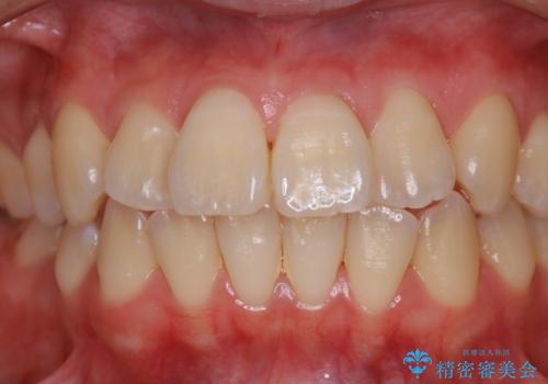 オフィスホワイトニングで白い歯にの治療前