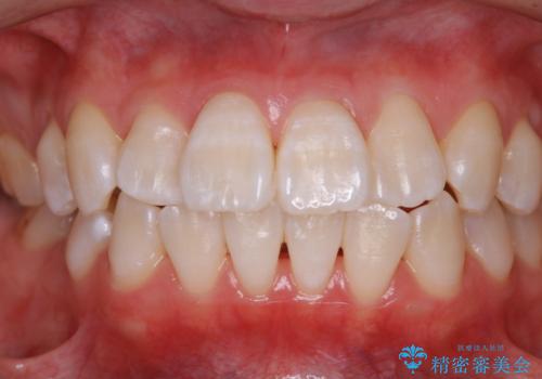 オフィスホワイトニングで白い歯にの治療後