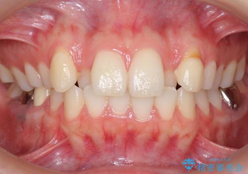 インビザラインで 抜歯矯正の治療前