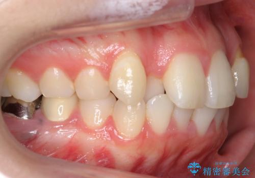 インビザラインで 抜歯矯正の治療前