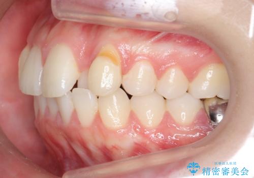 インビザラインで 抜歯矯正の治療前