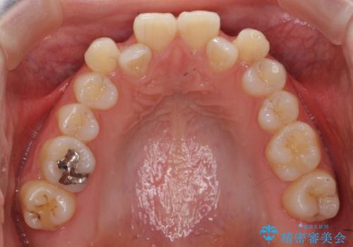 インビザラインで 抜歯矯正の症例 治療前
