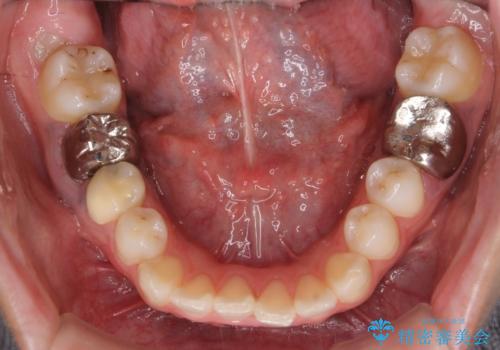 インビザラインで 抜歯矯正の治療前