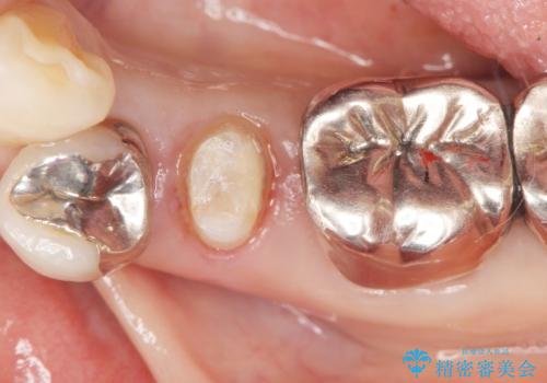 虫歯と歯並びを治したい 50代女性の治療中