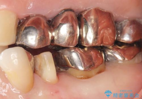 虫歯と歯並びを治したい 50代女性の治療中