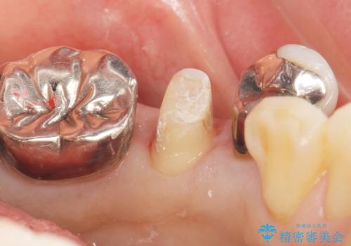 虫歯と歯並びを治したい 50代女性の治療中