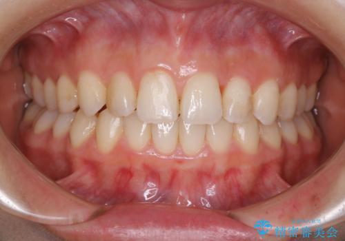 動きづらい前歯のねじれもマウスピース(インビザライン)で改善の症例 治療後