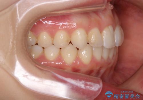 動きづらい前歯のねじれもマウスピース(インビザライン)で改善の治療後