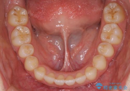 動きづらい前歯のねじれもマウスピース(インビザライン)で改善の治療後