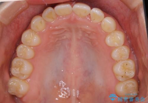 動きづらい前歯のねじれもマウスピース(インビザライン)で改善の治療後