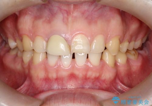 デュアルホワイトニング オフィスホワイトニングスペシャルコース+ホームホワイトニング