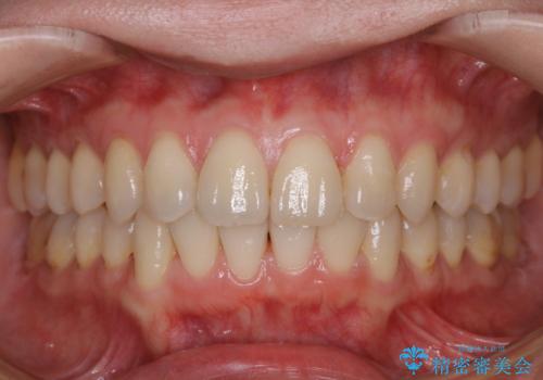 定期的にクリーニングを(PMTC)の治療前