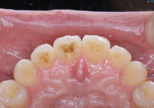 定期的にクリーニングを(PMTC)の治療前