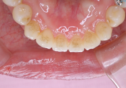 定期的にクリーニングを(PMTC)の治療前