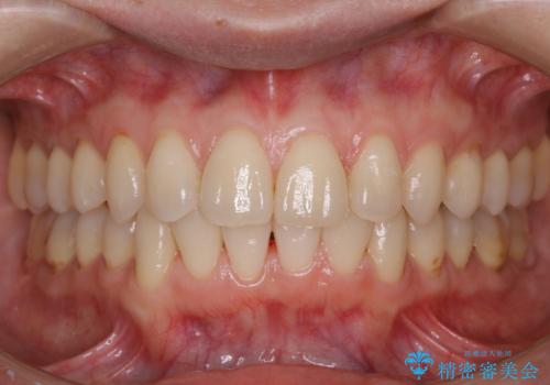 定期的にクリーニングを(PMTC)の治療後