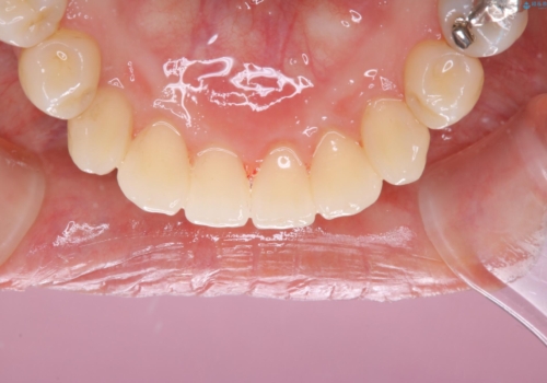 定期的にクリーニングを(PMTC)の治療後