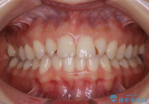動きづらい前歯のねじれもマウスピース(インビザライン)で改善の症例 治療前