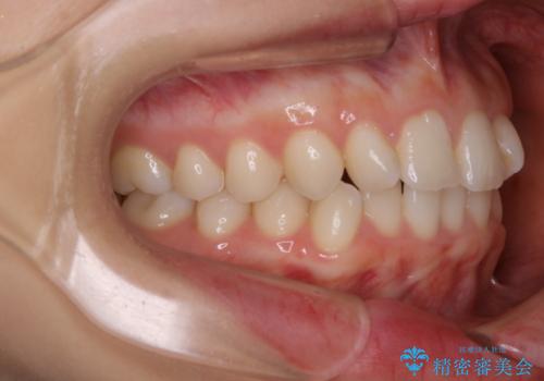 動きづらい前歯のねじれもマウスピース(インビザライン)で改善の治療前