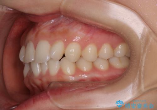 動きづらい前歯のねじれもマウスピース(インビザライン)で改善の治療前