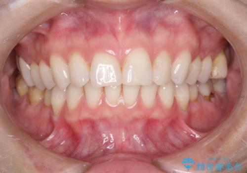 マスクにより気になる口臭を歯医者で予防の治療前