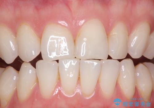 マスクにより気になる口臭を歯医者で予防の症例 治療前