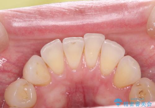 マスクにより気になる口臭を歯医者で予防の治療前