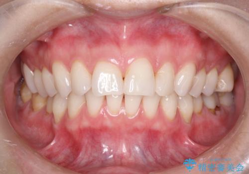 マスクにより気になる口臭を歯医者で予防の治療後