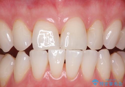 マスクにより気になる口臭を歯医者で予防