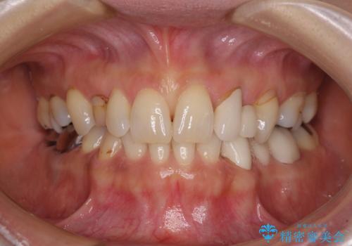 欠損の多い歯列　部分矯正とセラミックブリッジで自然な見た目にの治療前