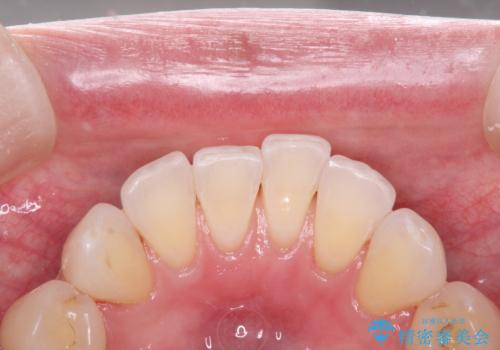 マスクにより気になる口臭を歯医者で予防の治療後