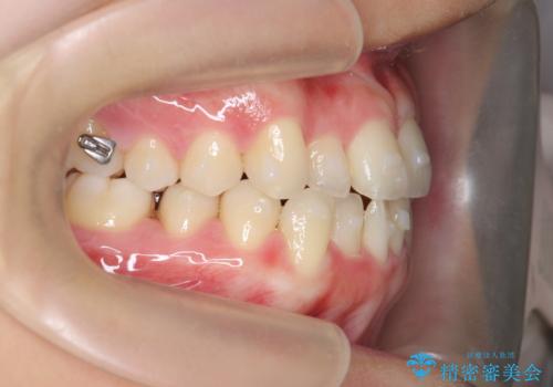 ガタつきの改善 マウスピース矯正治療の治療中