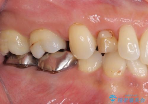 欠損の多い歯列 部分矯正とセラミックブリッジで自然な見た目にの治療前