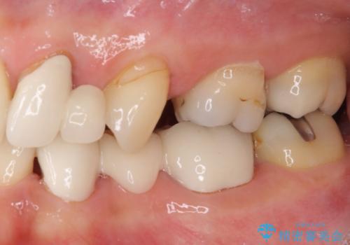 欠損の多い歯列 部分矯正とセラミックブリッジで自然な見た目にの治療前