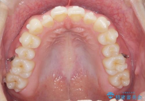 ガタつきの改善 マウスピース矯正治療の治療中